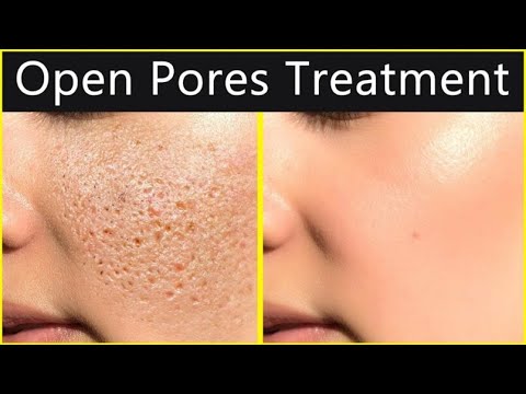 how to reduce open pores