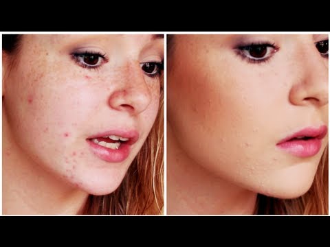 how to cover up acne