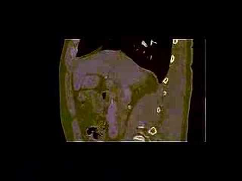 My CT Scan