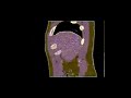 My CT Scan