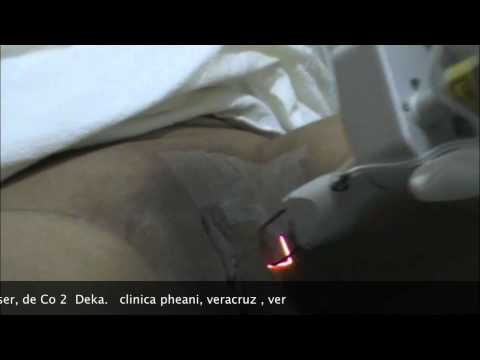 blanqueamiento genital - Dr. Roberto Solis : www.vaginoplastia-mexico.com.