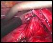 Laparoscopic gastric band revision -- Sydney (video 1/5)