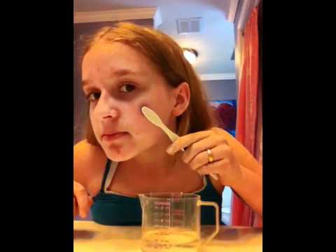 how to epsom salt acne