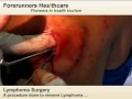Lymphoma surgery in India with best healthcare