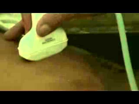 how to locate cbd on ultrasound