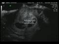 Sonogram - It's Twins!!
