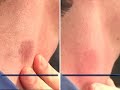 Getting rid of a hickey