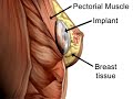 Breast Implant Incision Site - Under the Breast Fold