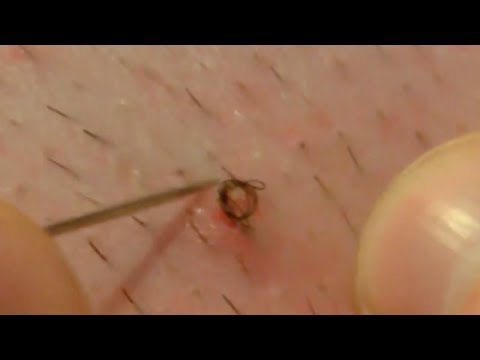 how to draw out an ingrown hair
