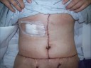 Tummy Tuck Picture Slide Show Tummy Tuck Picture Slide Show