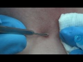 Neck Pimple Pop!