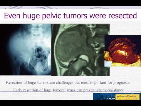 how to treat ewing's sarcoma