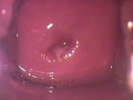 HPV. (COLPOSCOPIA ) DR. ARIEL RODRIGUEZ. UNION MEDICA, SANTIAGO, RD