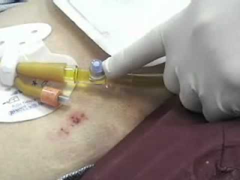 how to obtain urine specimen from a foley catheter