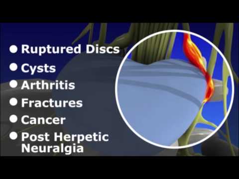 how to relieve epidural pain