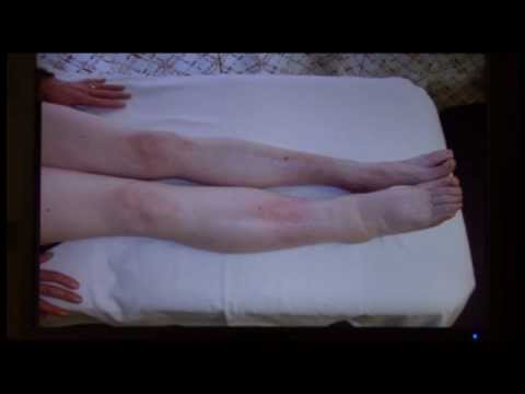 how to treat lymphedema
