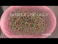 PCOS: Polycystic Ovary Syndrome