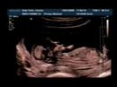 Ecograf�a bebe de Bary D�az :)