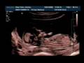 Ecografía bebe de Bary Díaz :)