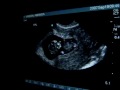 Ultrasound 10 weeks 3 days surrogacy
