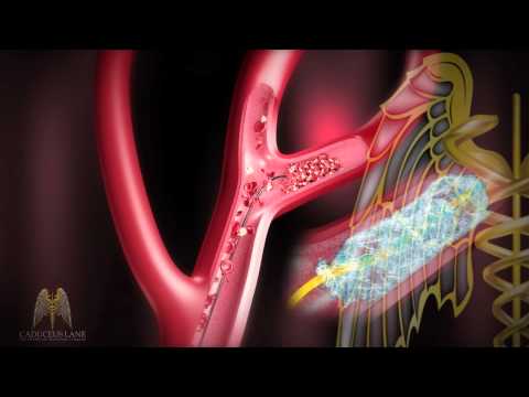 how to cure mild stroke