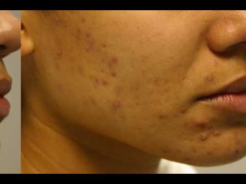 The Acne Practice  (3-D scars and acne)