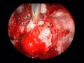 Adenoma Of Hypophysis, Endonasal Endoscopy Adenoma Of Hypophysis, Endonasal Endoscopy