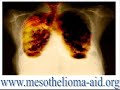 Support for Mesothelioma Patients - www.mesothelioma-aid.org AIDS - Living and Coping