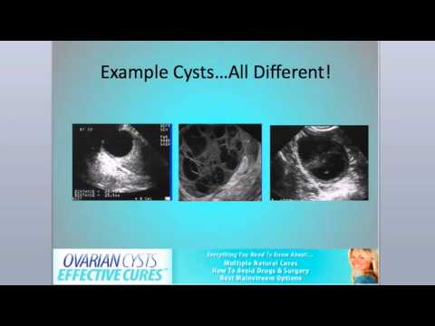 how to cure ovarian cyst