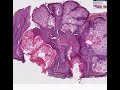 Histopathology Skin--Sebaceous hyperplasia Histopathology Skin--Sebaceous hyperplasia