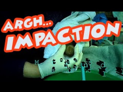 how to treat fecal impaction