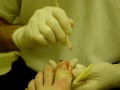 Ingrown Toenail Surgery Part 2