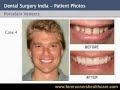 PORCELAIN VENEERS DENTAL SURGERY FOR BETTER LOOKING TEETH.