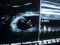 Transvaginal Ultrasound Pregnancy 6.4 weeks- Ultrasonido transvaginal de Embarazo de 6.4 semanas