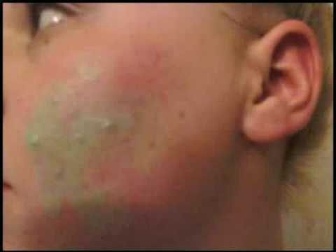 How to hide Acne/Acne scars!