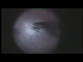 Sutureless gauge 20 vitrectomy Macular Hole