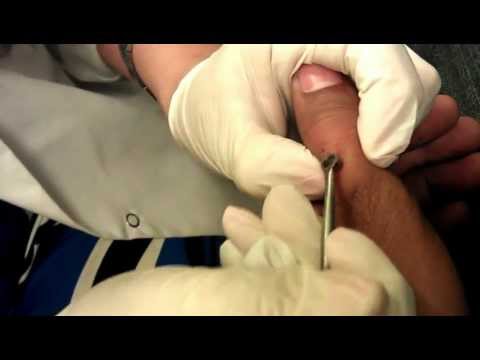 how to cure un ojo de pescado