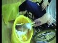 Ампутация левой ноги (Последствия приема Коаксила)
