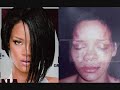 Rihanna's bruised face Rihanna's bruised face