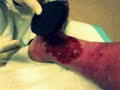 Wound VAC Dressing change 1 of 2