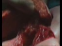 Trattamento delle piaghe da decubito con espansione cutanea Trattamento delle piaghe da decubito con espansione cutanea