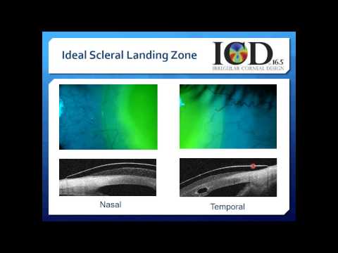 how to fit scleral lenses