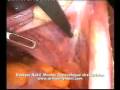 laparoscopic supracervical hysterectomy (full video)