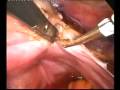 laparoscopic supracervical hysterectomy (full video)