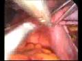 laparoscopic supracervical hysterectomy (full video)