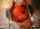 Transpulmonary Bronchostomy for total trachea removal
