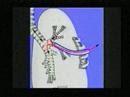 Transpulmonary Bronchostomy for total trachea removal
