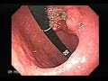 Endoscopy of Small Gastric Cancer taken by Dr. Julio Murra S