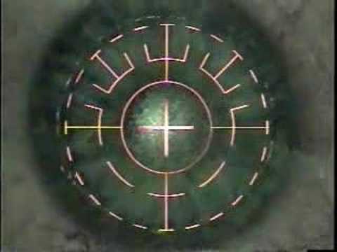 PRK Eye Surgery