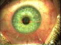 PRK Eye Surgery PRK Eye Surgery